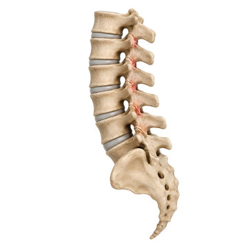 Lumbar Spine Facet Joint Arthritis 3D Medical Render for Patient Education and Healthcare Use