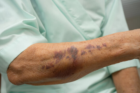 Ecchymosis, elderly bleeding on her arm after taking aspirin.