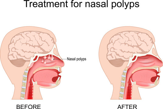 Nasal polyps treatment. Nasal sinus anatomy before and after endoscopic sinus surgery or steroid therapy. Cross-section of human nasal cavity