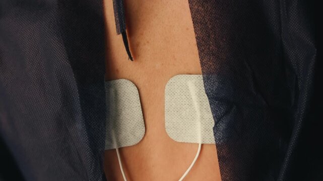 Close-up of electrical muscle stimulation pads attached to a back. Physiotherapy, pain relief, and rehabilitation treatment concept. High quality 4k footage
