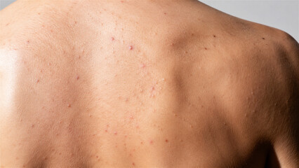 Naklejka premium man with acne on back. Close-up of skin condition with pimples and inflammation. Dermatological problem and medical skincare concept for treatment of back breakouts and blemishes