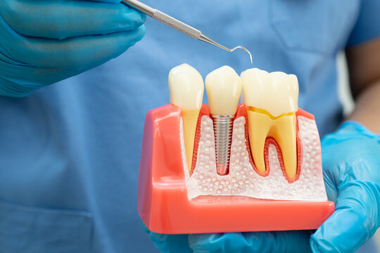 Dentist holding dental implant, artificial tooth roots into jaw, root canal of dental treatment, gum disease, teeth model for dentist.