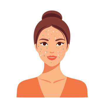 Illustration of a young woman with acne on her face