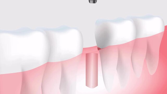 Close-up illustration showcasing a dental implant being surgically placed into the gum and bone beneath a missing tooth