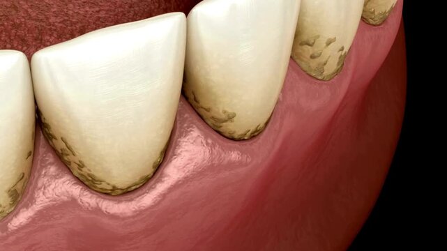 Close up illustration showing unhealthy teeth with plaque buildup along the gum line