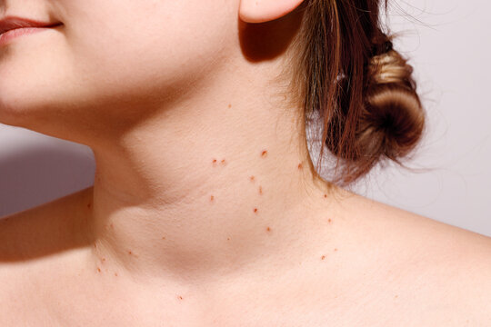 Close-up of woman's neck skin with multiple small red dots after laser papilloma removal