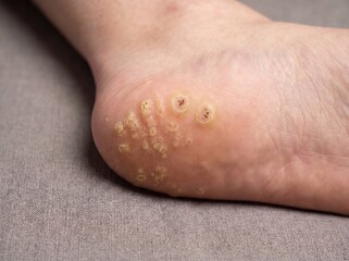 Fototapeta premium A professional photography shot of a person's foot showing a cluster of plantar warts caused by HPV, displaying small, grainy skin growths with a rough texture and tiny black dots in the center, neutr