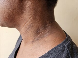 Naklejka premium A professional photography close-up shot of a person's neck displaying Acanthosis Nigricans, featuring velvety, darkly pigmented, thick patches of skin in the body folds, neutral background.