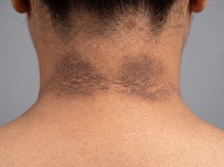 Fototapeta premium A professional photography close-up shot of a person's neck displaying Acanthosis Nigricans, featuring velvety, darkly pigmented, thick patches of skin in the body folds, neutral background.