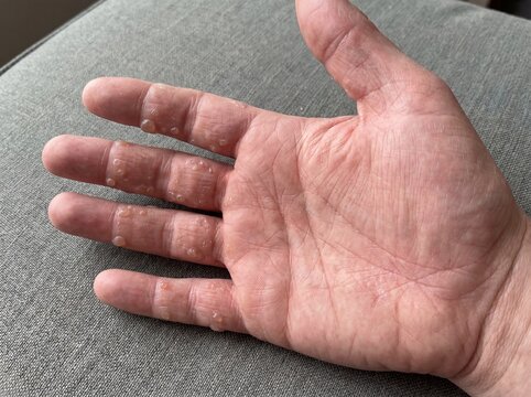 A professional photography close-up shot of a person's hand affected by Dyshidrotic Eczema, showing tiny, deep-seated, intensely itchy blisters along the sides of the fingers and palms, sharp focus, n