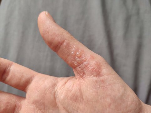 A professional photography close-up shot of a person's hand affected by Dyshidrotic Eczema, showing tiny, deep-seated, intensely itchy blisters along the sides of the fingers and palms, sharp focus, n