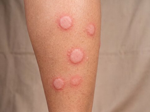 A professional photography macro shot of a person's leg demonstrating Hives (Urticaria), showing multiple raised, swollen wheals that are pale in the center and surrounded by a distinct red halo, smoo