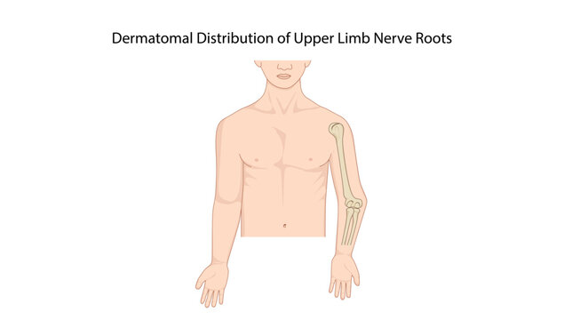 Dermatomal Distribution of Upper Limb Nerve Roots
sensory dermatome distribution of the upper limb and corresponding cervical spinal nerve root innervation.