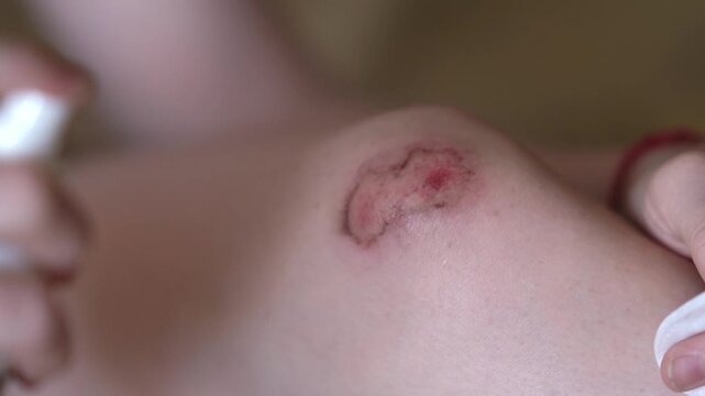 A teenager uses a prophylactic agent to treat an abrasion on their knee. Treating the wound with hydrogen peroxide. High quality FullHD footage