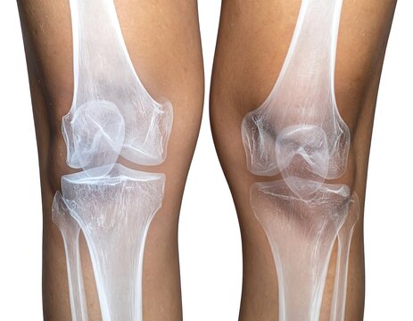 Medical illustration showing skeletal structures of the human knee from frontal and lateral angles, against a white background