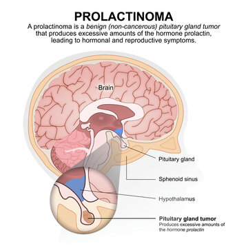 Prolactinoma, Non Cancerous) Pituitary gland tumor