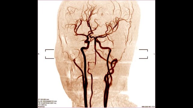 angiography by mri or mra blood vessels x-ray images to show brain stroke and aneurysm or ischemic.