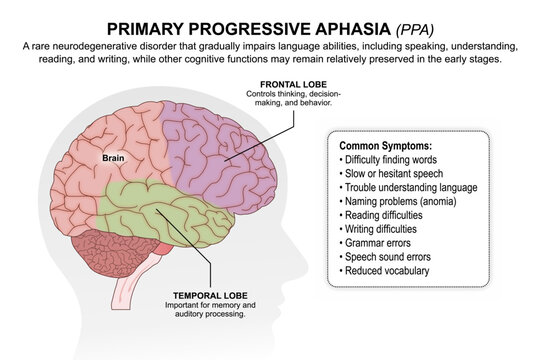 Primary Progressive Aphasia (PPA)