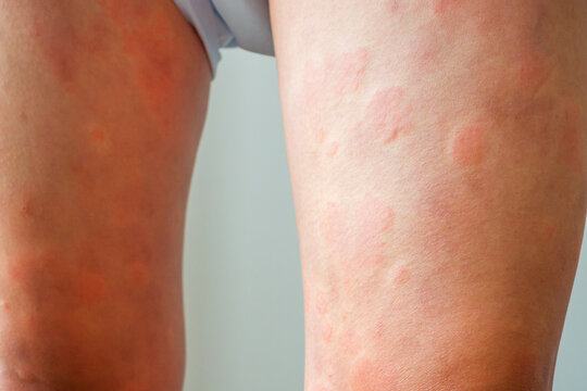 Young asian man has allergic skin rash on his legs from itchy dry skin eczema dermatitis insect bites