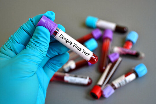 Medical professional holding a dengue virus test tube with blood samples for diagnosis