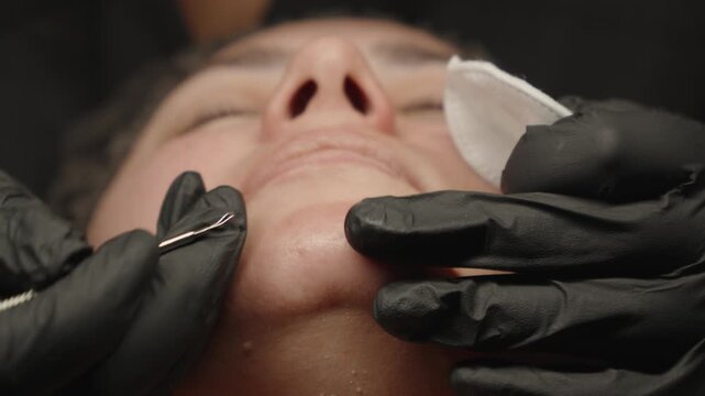 Cosmetologist using comedone extractor tool on female client chin
