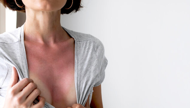 Close up of a young woman showing severe red sunburn and distinct tan lines on her chest and neck area