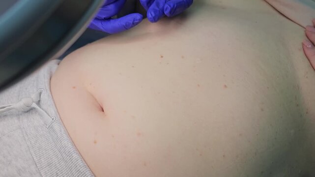 Professional removal of papillomas and moles with electrocoagulation procedure in dermatology clinic. overweight European woman on the surgical table. moles papillomas neoplasms on the body