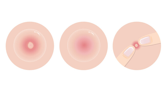 The way to get rid of acne pimple vector icon set illustration on white background. Zit away with patch absorb pus and excess oil on inflammatory acne, pustule on skin and squeeze pimple with finger.