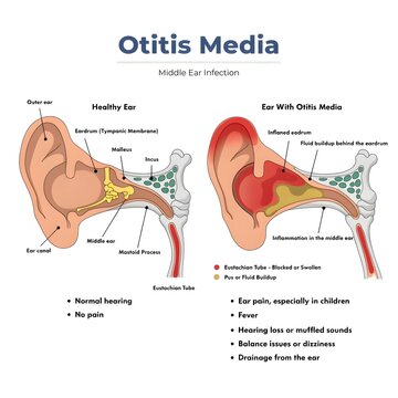 Diagram illustrating a healthy ear versus an ear suffering from otitis media middle ear infection and its symptoms