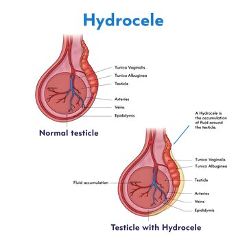 Detailed anatomical diagram illustrating the comparison between a normal testicle and a testicle affected by hydrocele