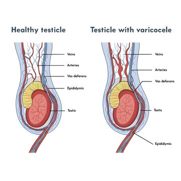 Anatomical illustration comparing a healthy human testicle with a testicle affected by varicocele showing veins arteries and vas deferens