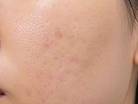 Close up of facial skin with acne, dark spots, freckles, and hyperpigmentation