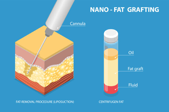 3D Isometric Flat Vector Illustration of Liposuction, Fat Removal And Nano-Fat Transfer.