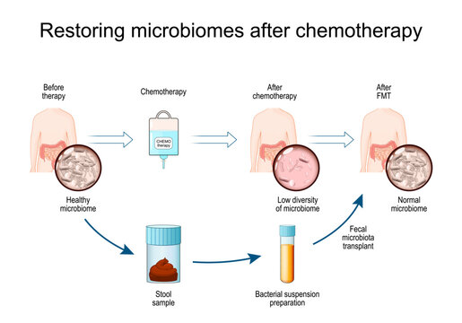 Restoring microbiomes after chemotherapy. Human body and gut microbiota Before and After chemotherapy and FMT therapy.
