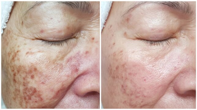 Woman face before and after laser pigment treatment. Comparison of skin with age spot and hyperpigmentation reduction. Result of cosmetic procedure for anti aging rejuvenation therapy
