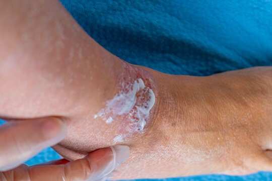 Applying medicated cream, ointment on irritated skin ankle, eczema treatment, dermatology care, chronic inflammation relief, doctor treats large healing wound, sores on limbs, tissue regeneration