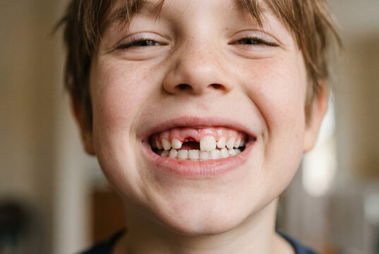 Close up of a smiling boy showing a newly missing front baby tooth
