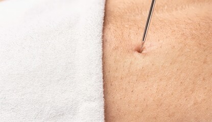 Fototapeta premium Acupuncture session focusing on a person's shoulder area in a clinic setting during the afternoon