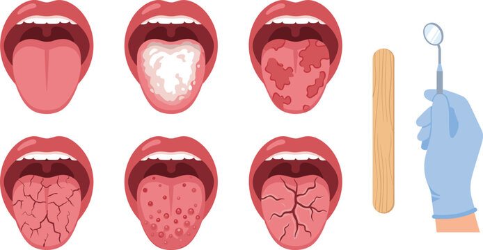 Tongue Disease and Oral Health Symptoms Collection with Infections Inflammation and Medical Examination Vector Illustration Set