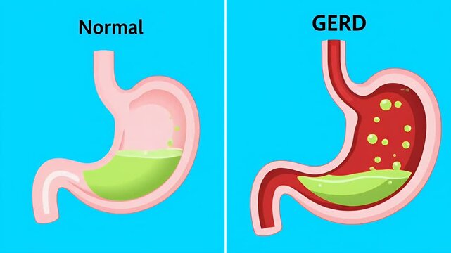 GERD stomach acid reflux comparison illustrating normal and diseased states on blue.