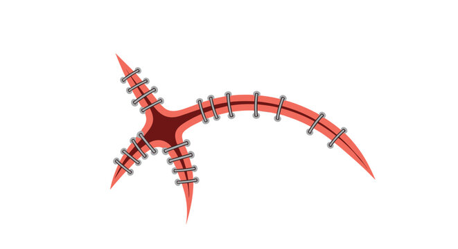 Detailed medical illustration showing a cross shaped surgical incision on skin closed with metal staples and blue sutures for healing.
