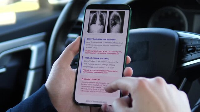 Viewing a Patient Dashboard with chest radiography results on a smartphone. The screen displays findings of rib fractures and a compression fracture. Perfect for telemedicine, trauma diagnostics, and