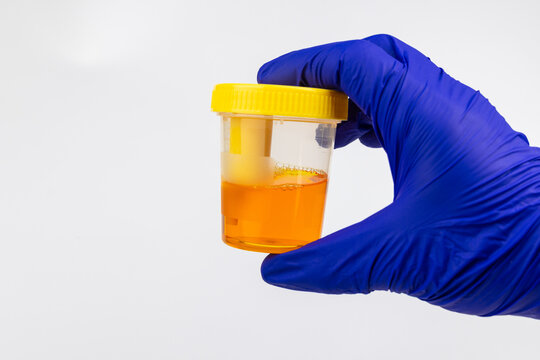 A hand in blue protective glove holding a plastic container filled with a yellow liquid urine sample for medical laboratory testing