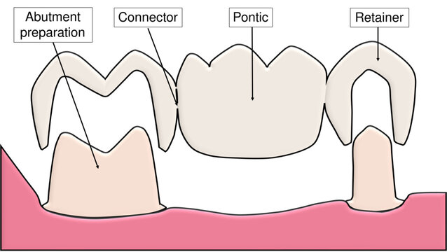 Three Unit Fixed Partial Denture - Labelled