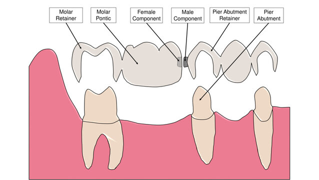 Pier Abutment Fixed Partial Denture Non Rigid Connector Dental Diagram - Labelled
