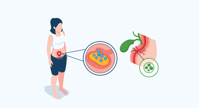 Woman suffering from stomach pain with medical illustration of gallstones blocking the gallbladder and bile ducts.