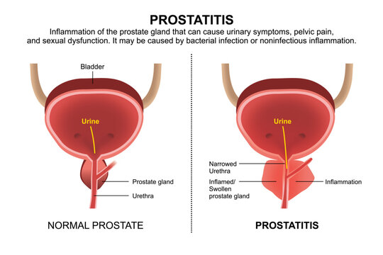 Prostatitis, Inflammed Prostate Gland Illustration