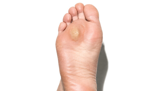 human foot with large callus on the sole. Dermatological problem showing rough skin thickening. Podiatry health concept for foot care, skin treatment, and medical condition analysis
