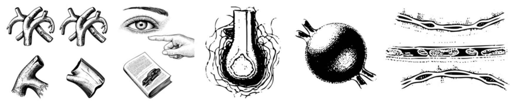 This vintage anatomical sketch features a vascular aneurysm, often called a bulge or vessel swelling, alongside detailed artery segments and a clinical eye observation.