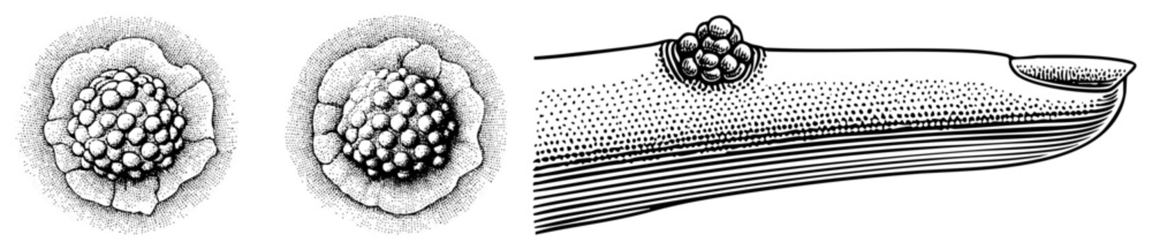 Detailed stipple engraving showing a skin growth or wart on a human finger, illustrating a bump or verruca with precise anatomical textures and fine dot work.